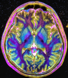 "Max contrast Brain MRI 131058 rgbce" by Nevit Dilmen (talk) - Own work. 